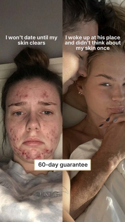 Acne Gummies